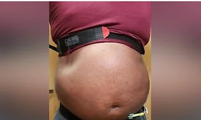 N2o Belly Inflation